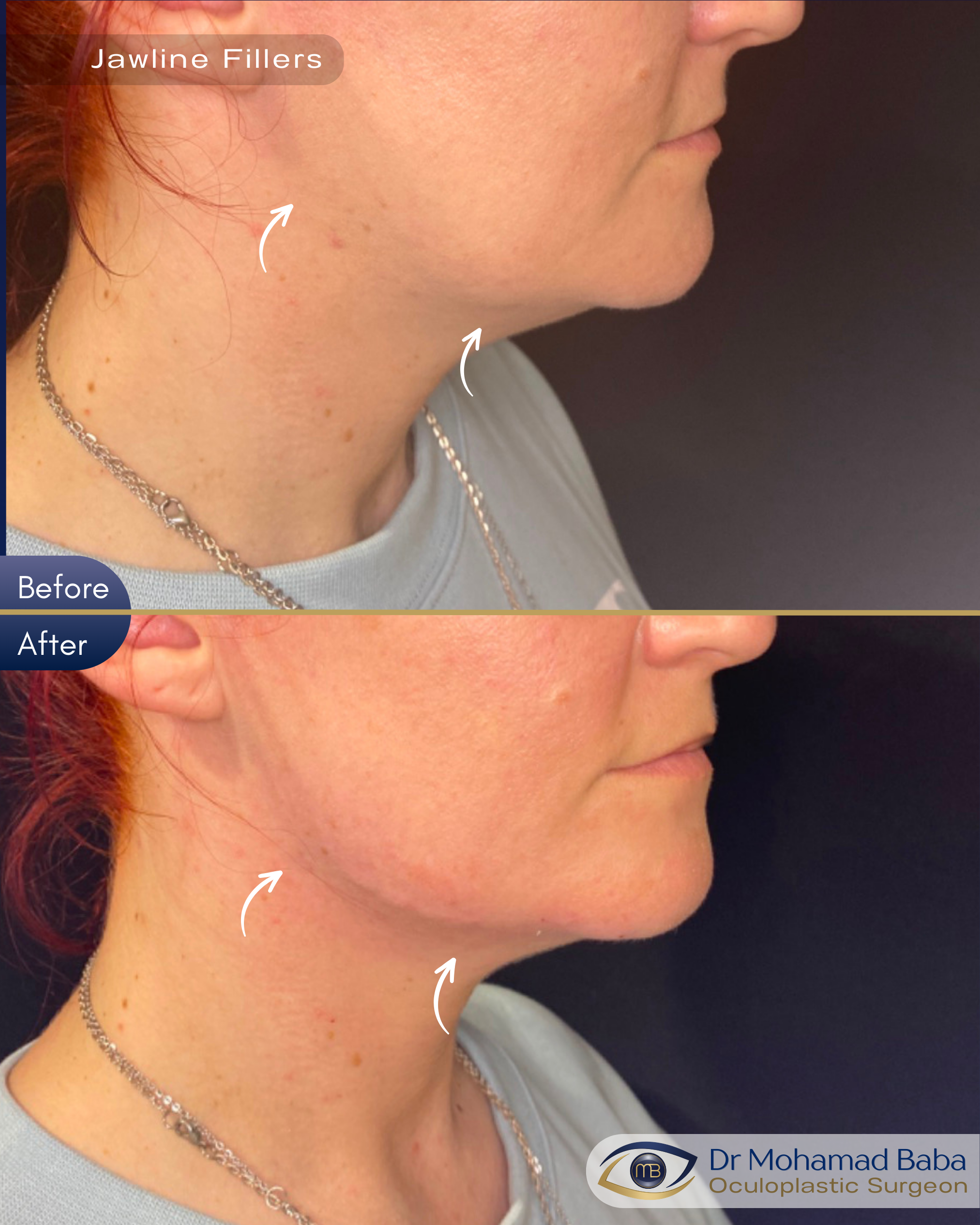 Dermal Fillers