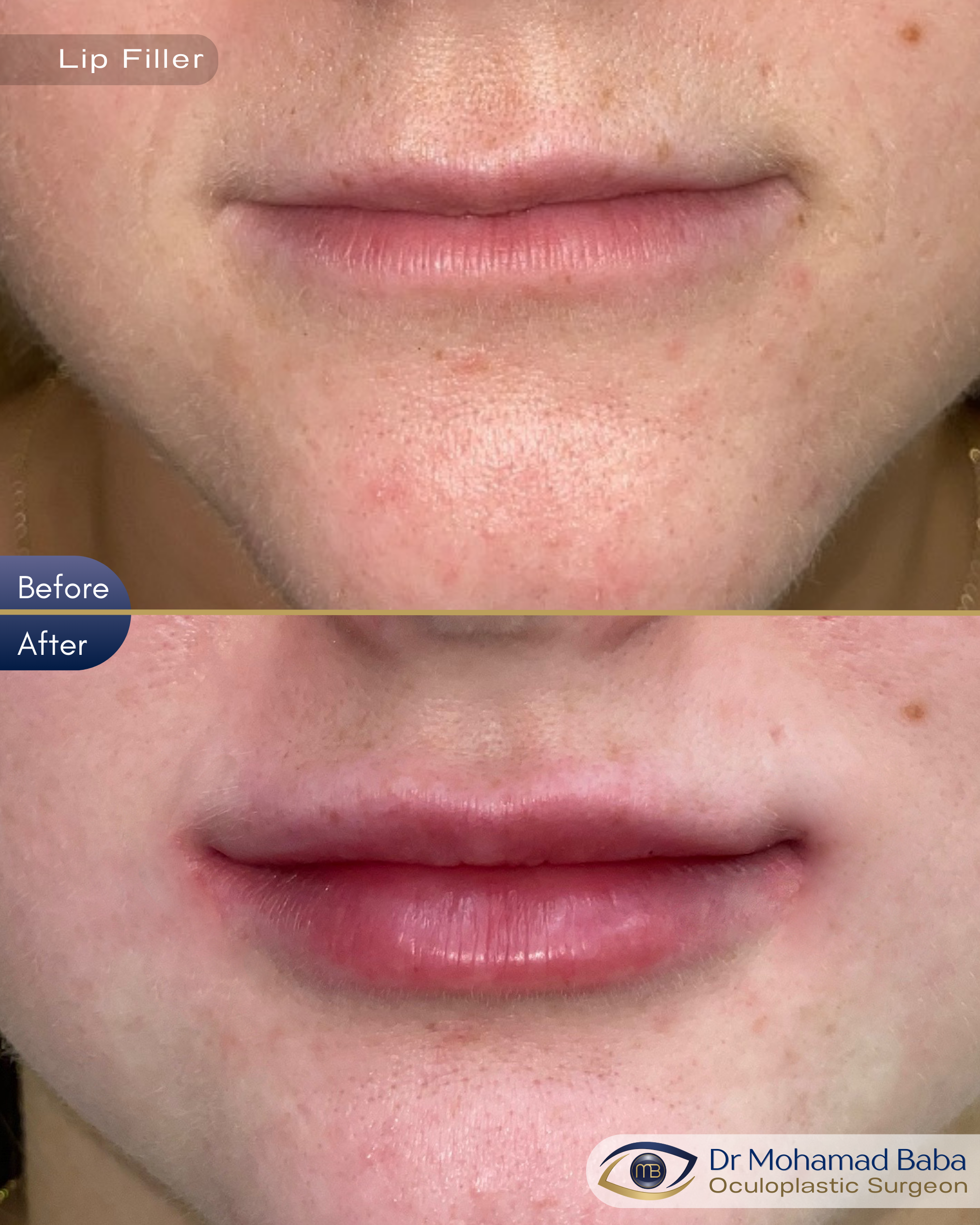 Lip filler 1 - Carleen McCord
