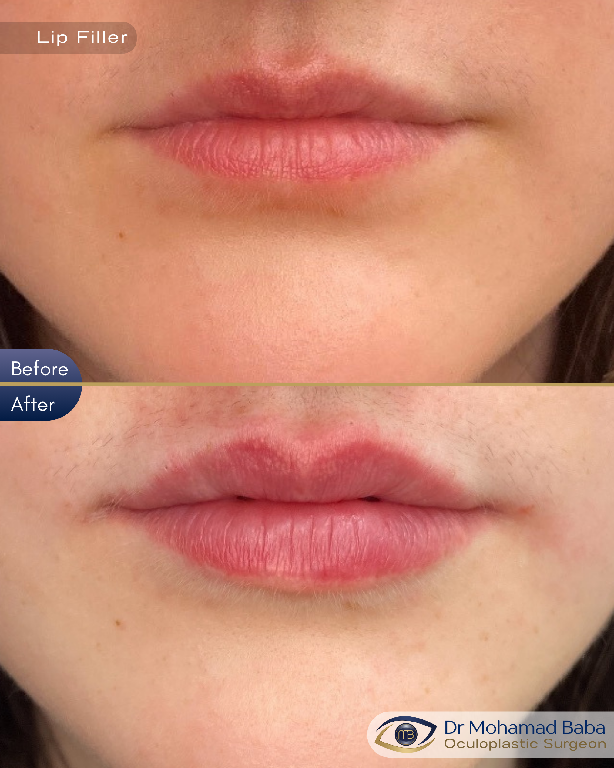 Lip filler 10 - Jessica Miller