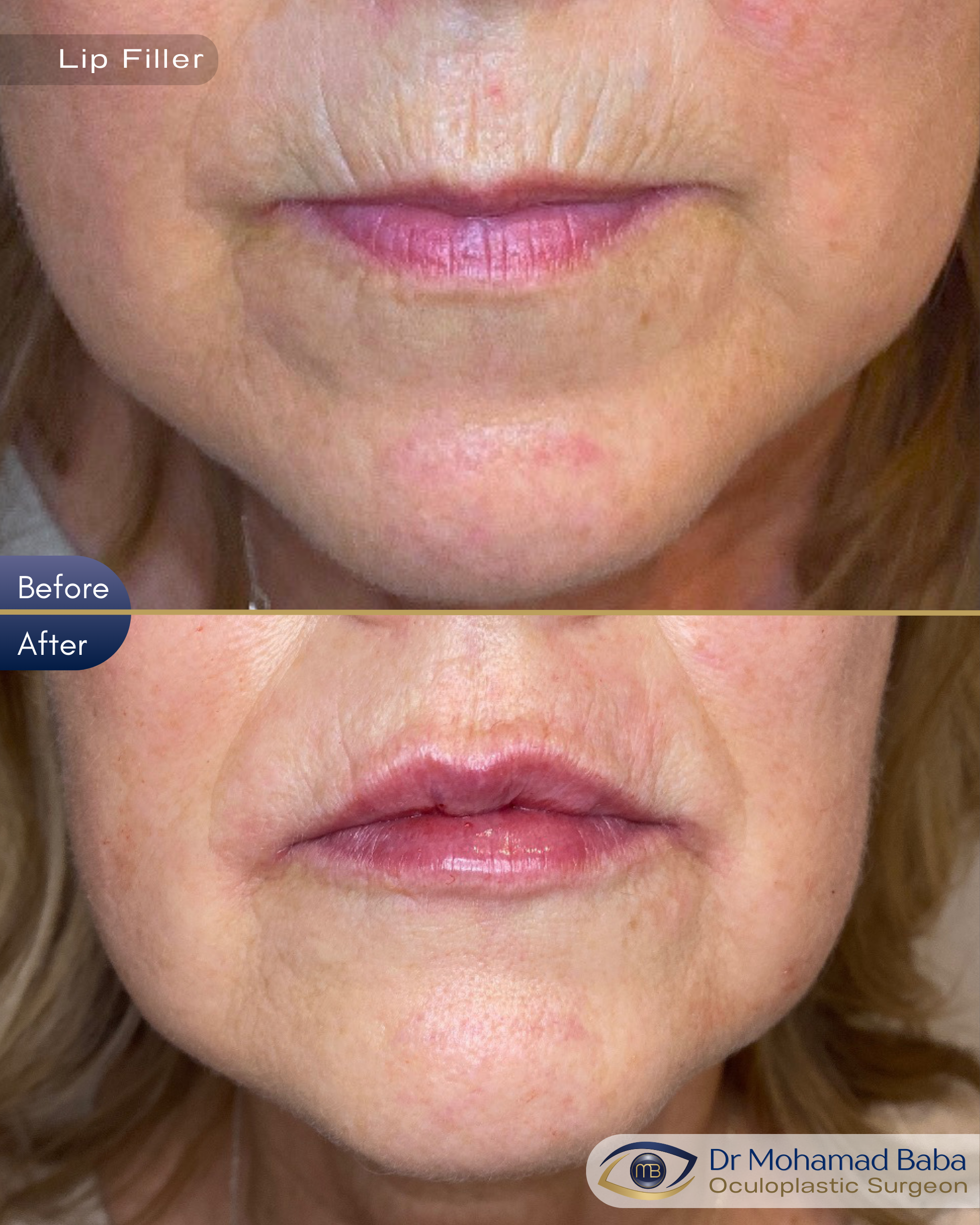 Lip filler 12 - Pamela Matchett