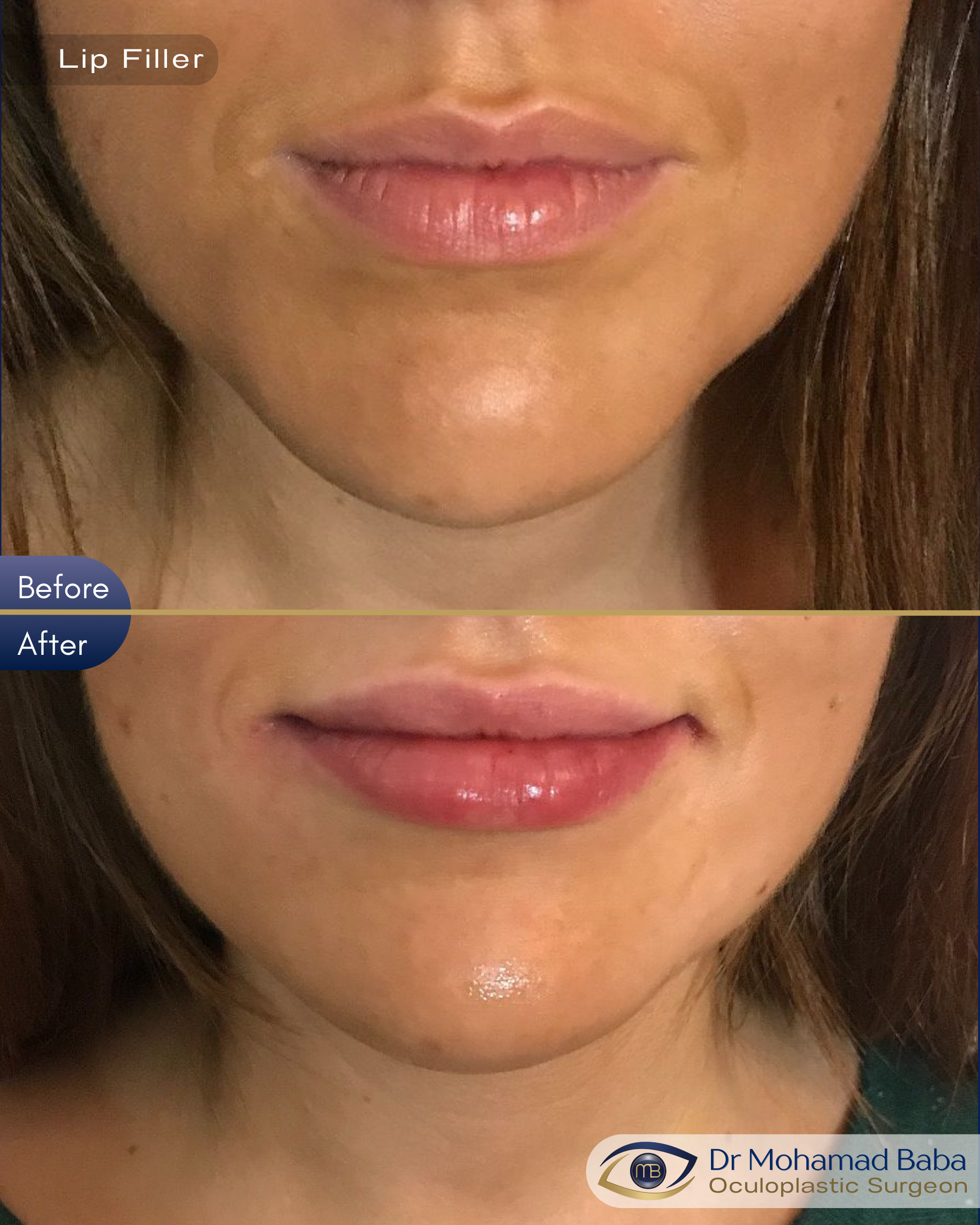 Lip filler 2 - Linzi Sparks