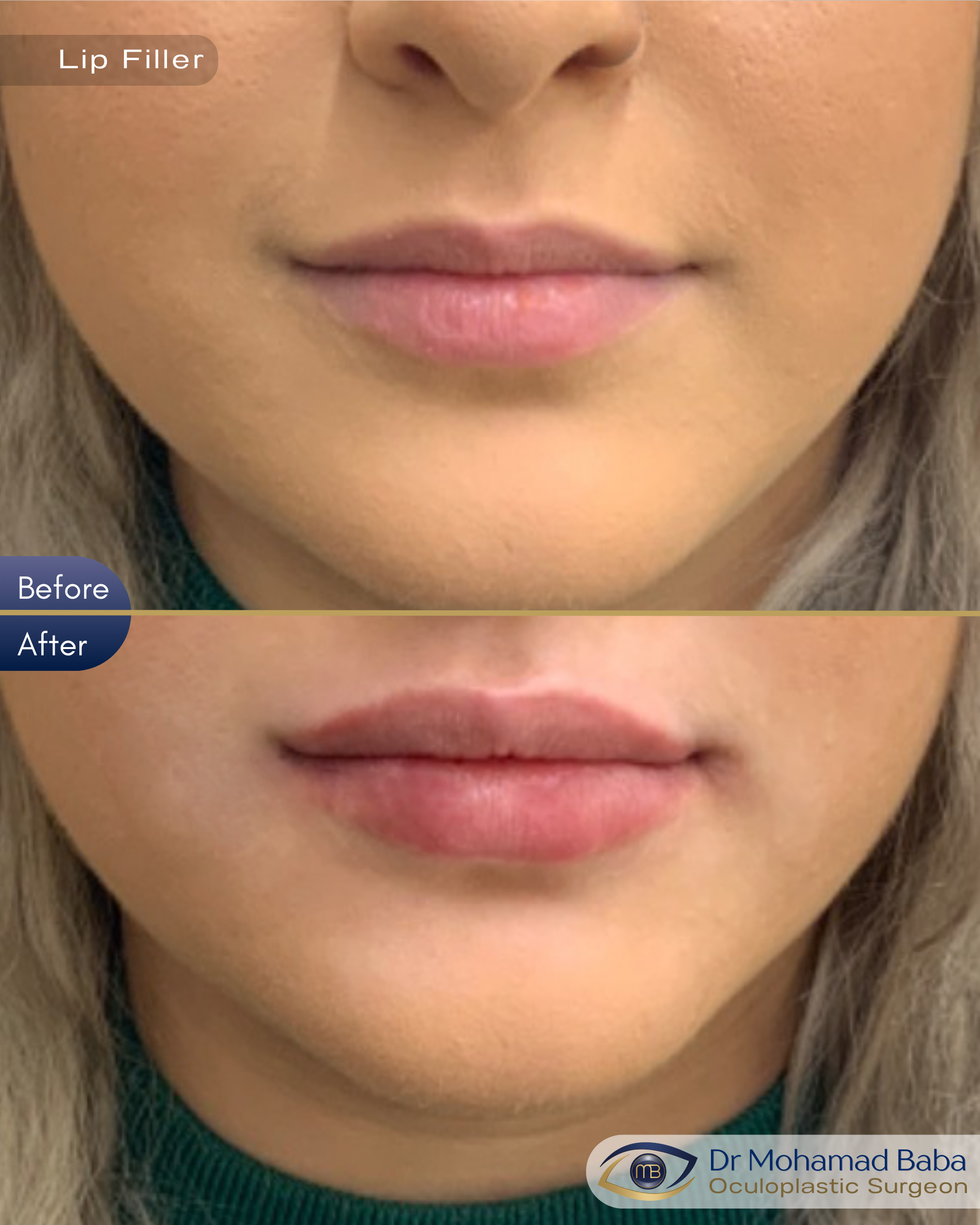 Lip filler 3 - Lauren Nicholson
