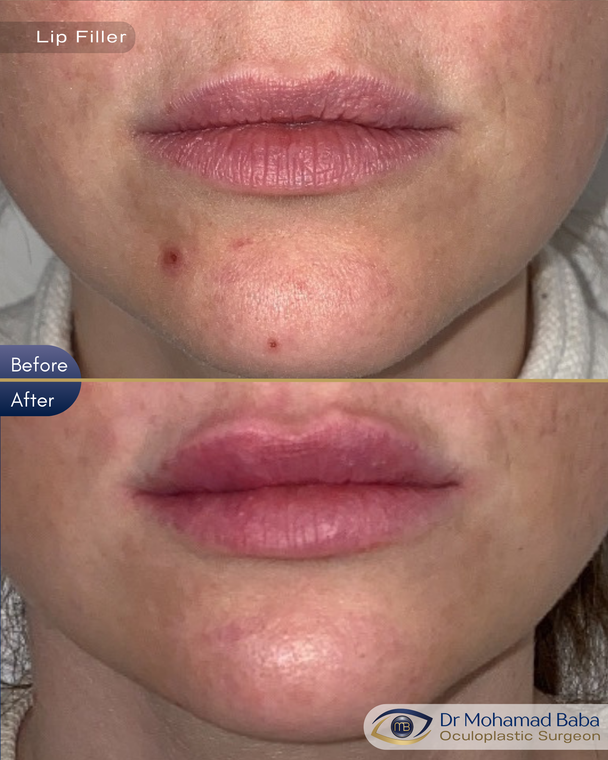 Lip filler 4 - Jacqueline McMullan