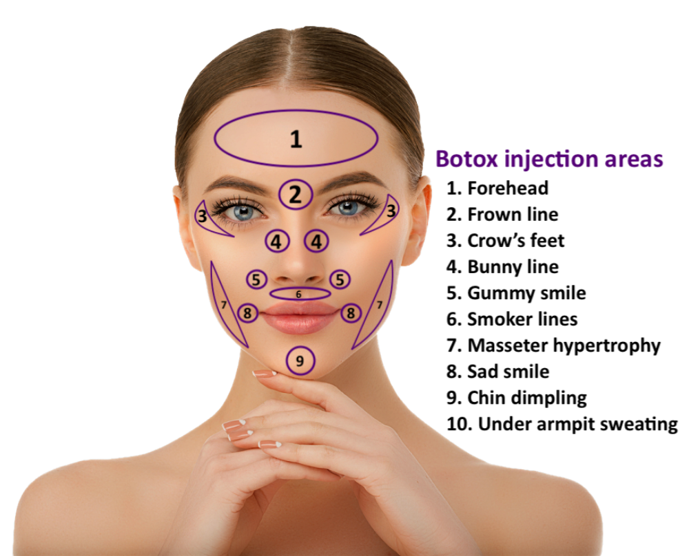 Where can Botox® be injected?